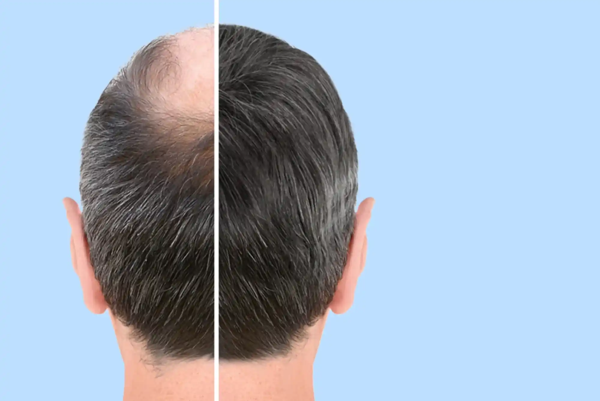 هل زراعة الشعر في دبي تستحق الاستثمار؟