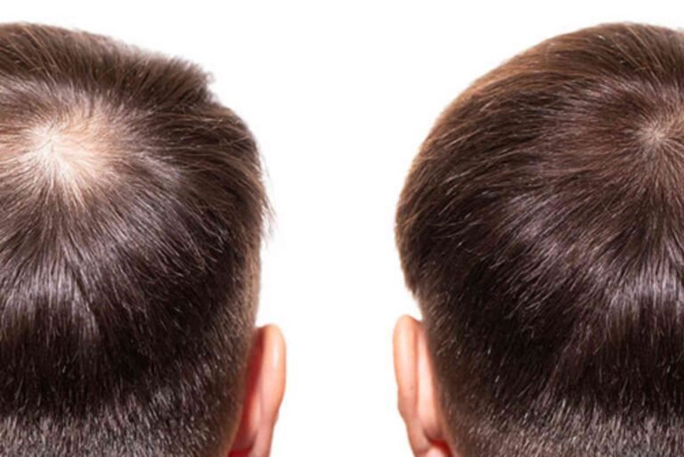 Best Hair Transplat Turkey