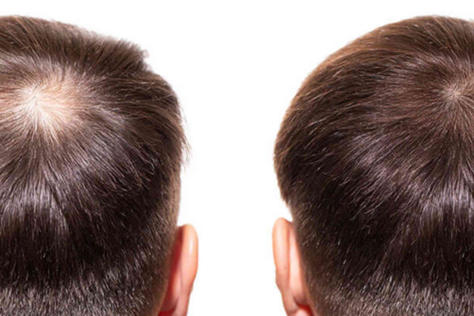 Best Hair Transplat Turkey